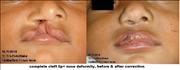 Before After Pictures,Cosmetic surgery,Delhi,complete cleft lip & nose